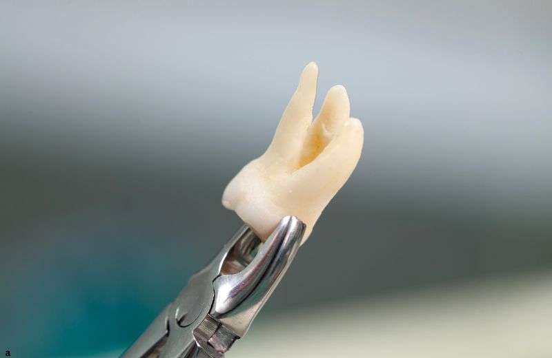 Tooth Extraction