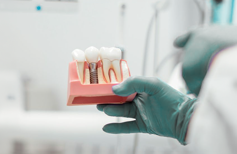 Dental Implants