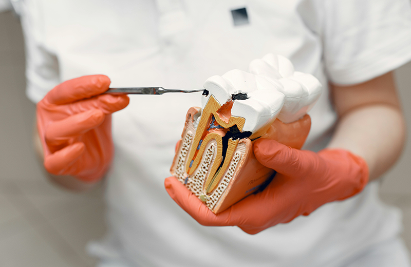 Root Canal Treatment