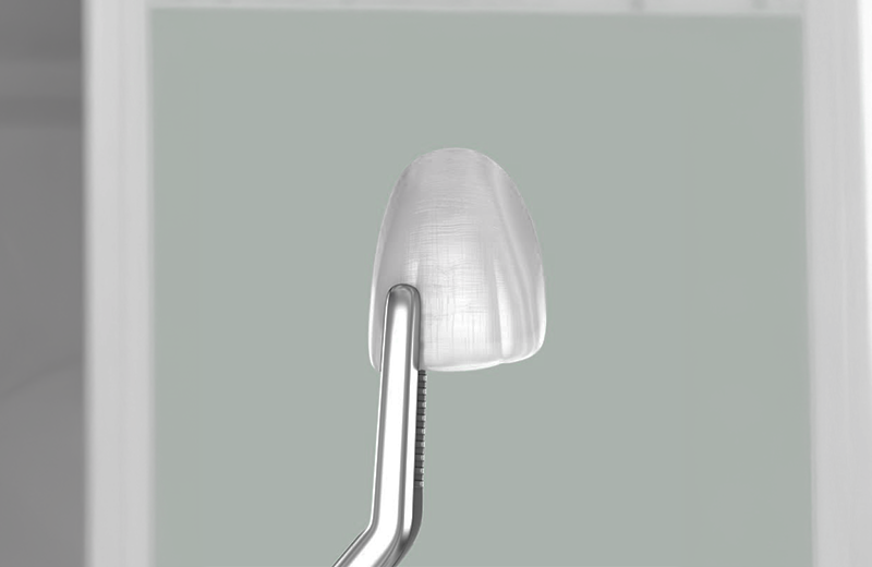 Veneers