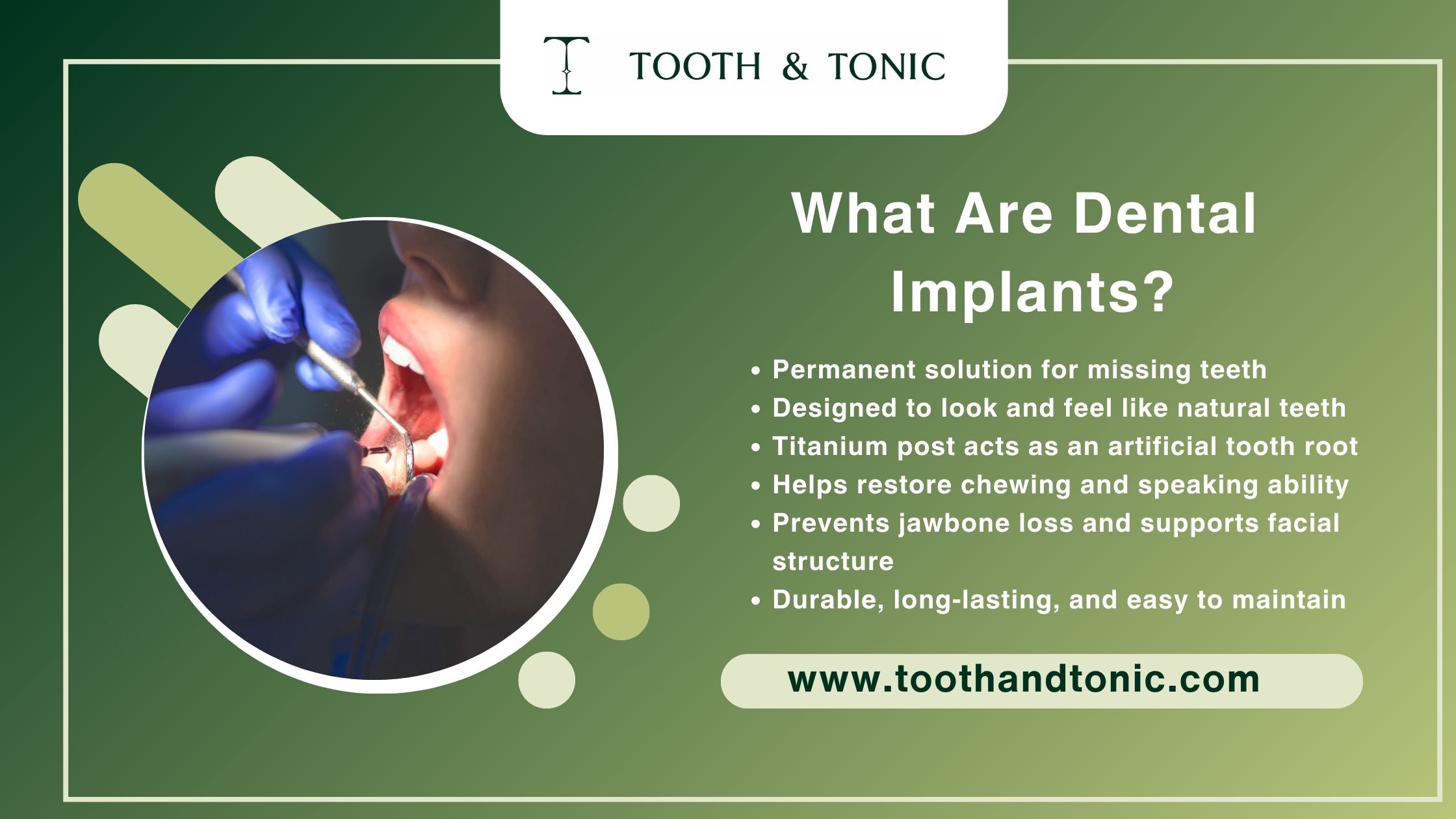 What Are Dental Implants?