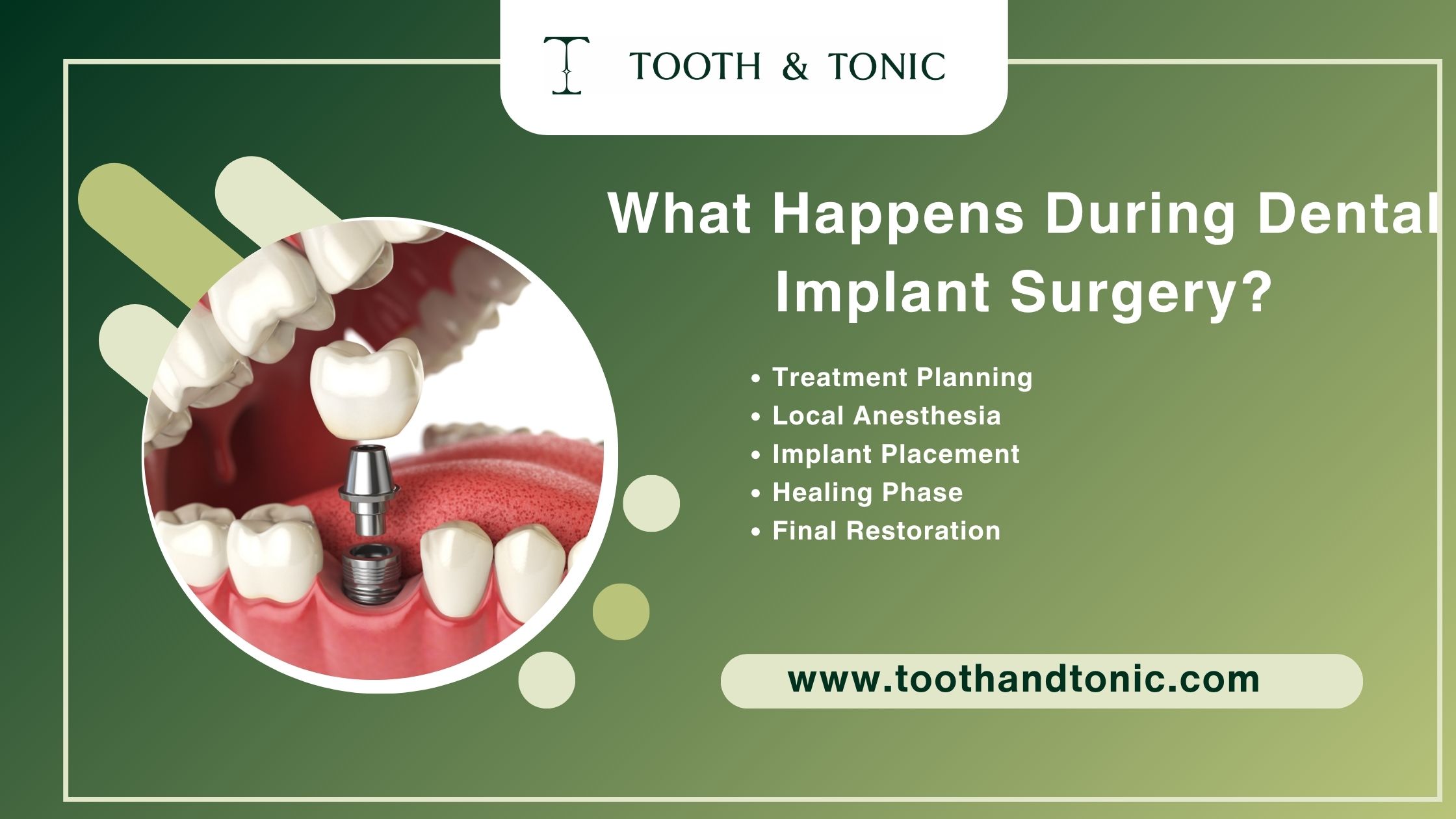 What Happens During Dental Implant Surgery