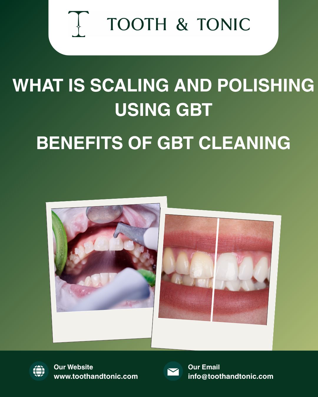 What Is Scaling and Polishing Using GBT? Benefits of GBT Cleaning