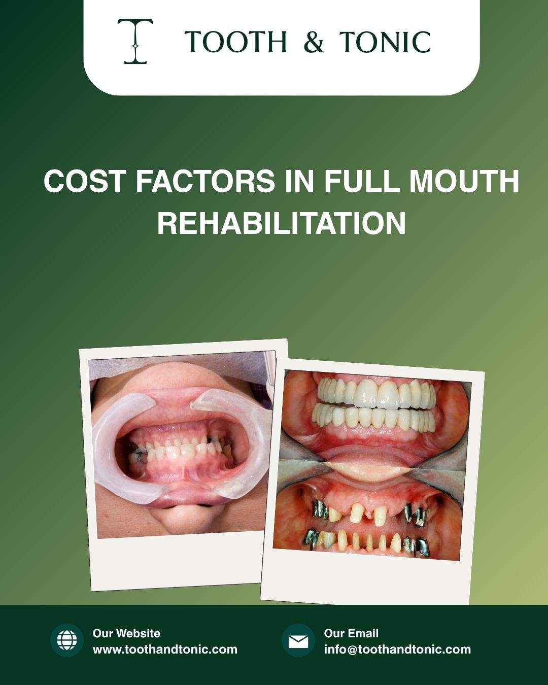 Cost Factors in Full Mouth Rehabilitation
