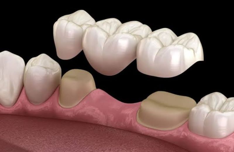 Dental Bridges