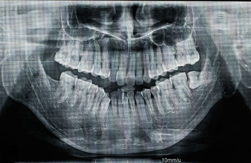 OPG Dental X-Ray