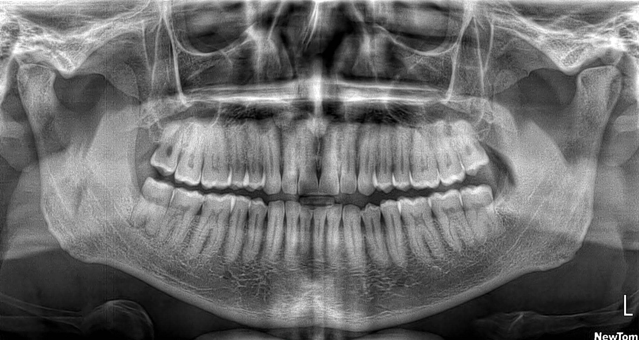 OPG Dental X-Ray