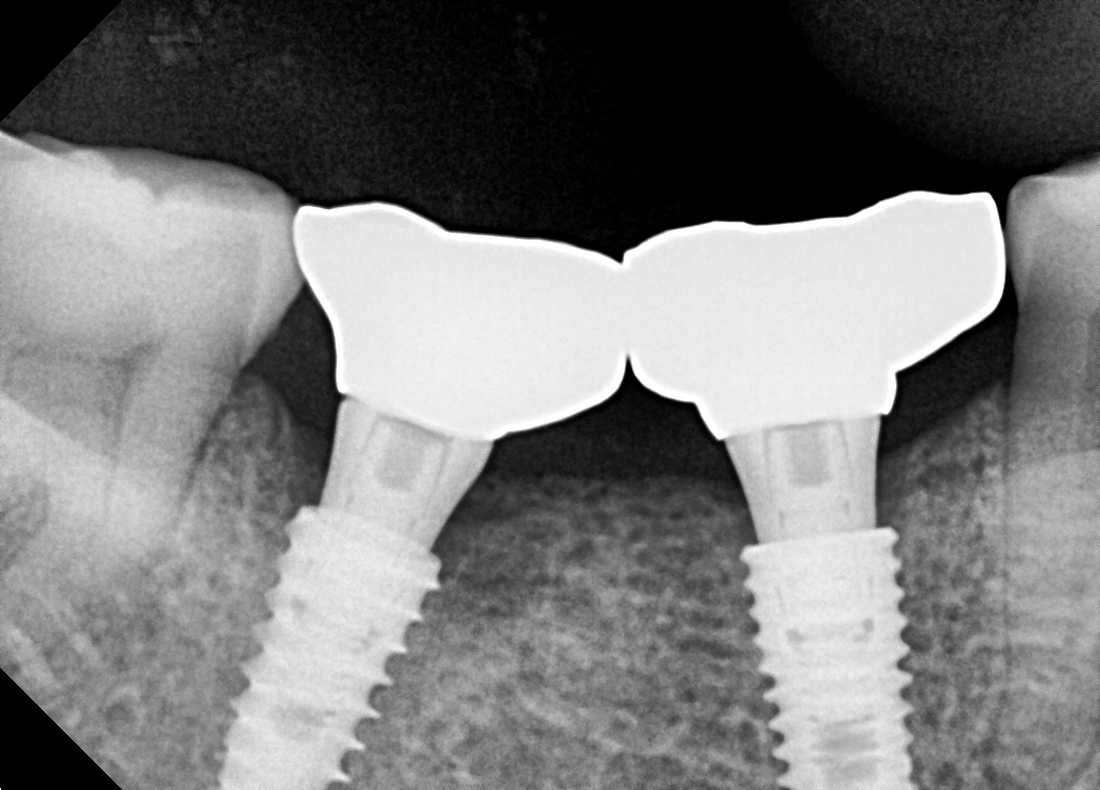 RVG X-Ray