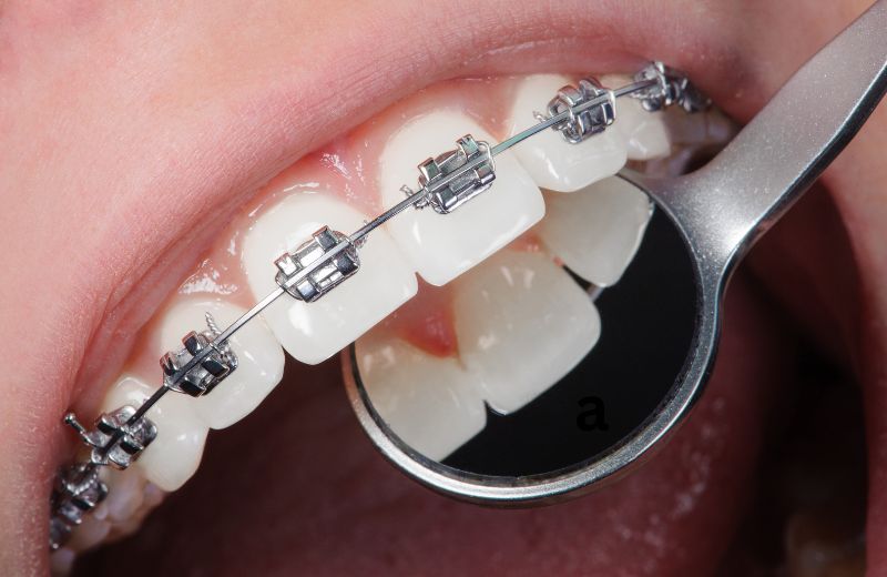 Teeth Braces