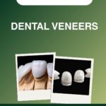 Dental Veneers