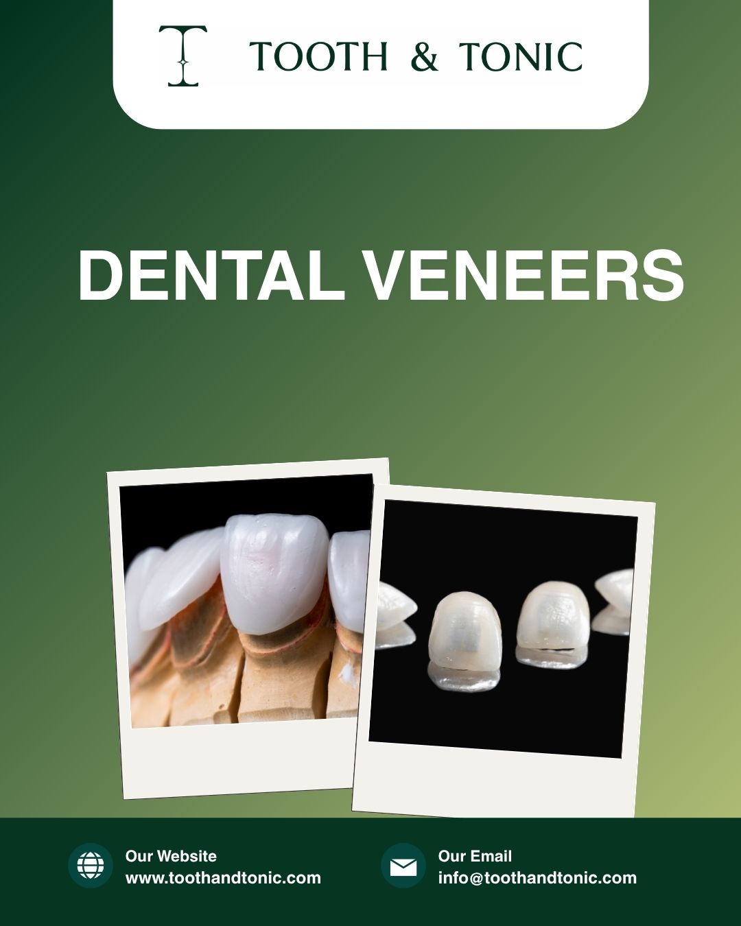 Dental Veneers